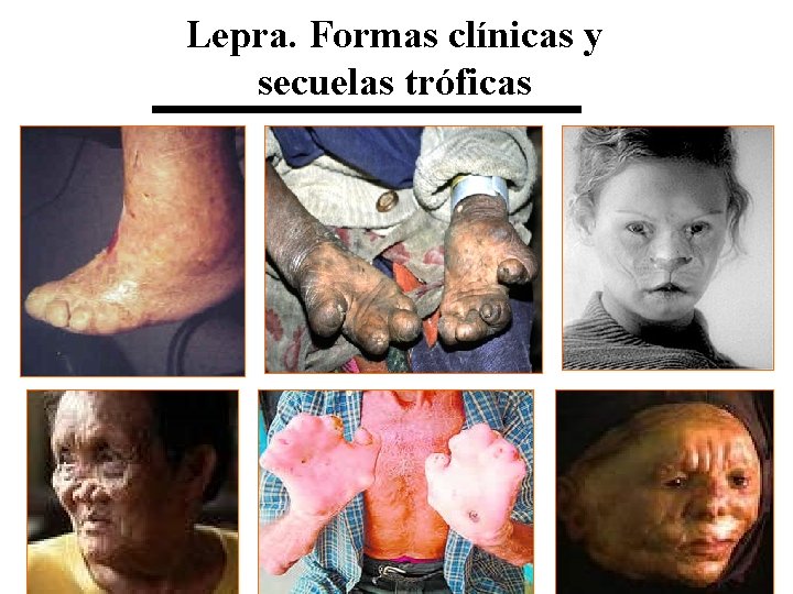 Lepra. Formas clínicas y secuelas tróficas 