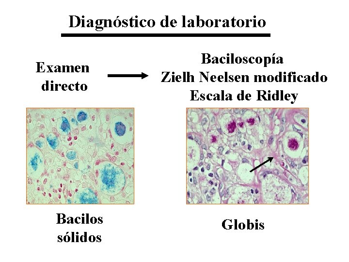 Diagnóstico de laboratorio Examen directo Bacilos sólidos Baciloscopía Zielh Neelsen modificado Escala de Ridley