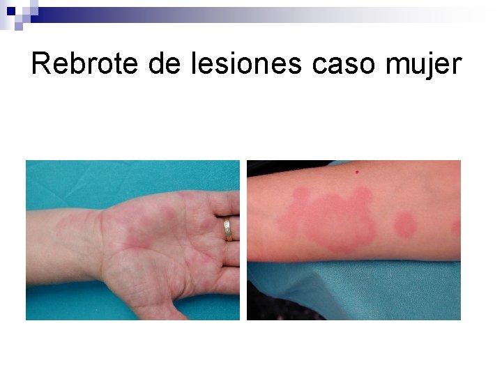Rebrote de lesiones caso mujer 