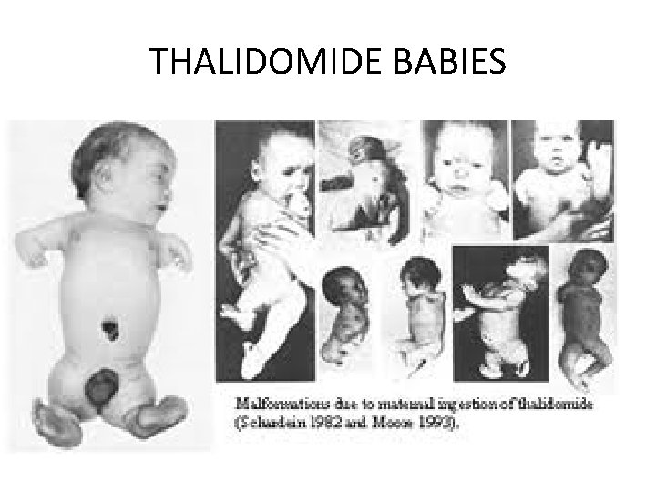 THALIDOMIDE BABIES 