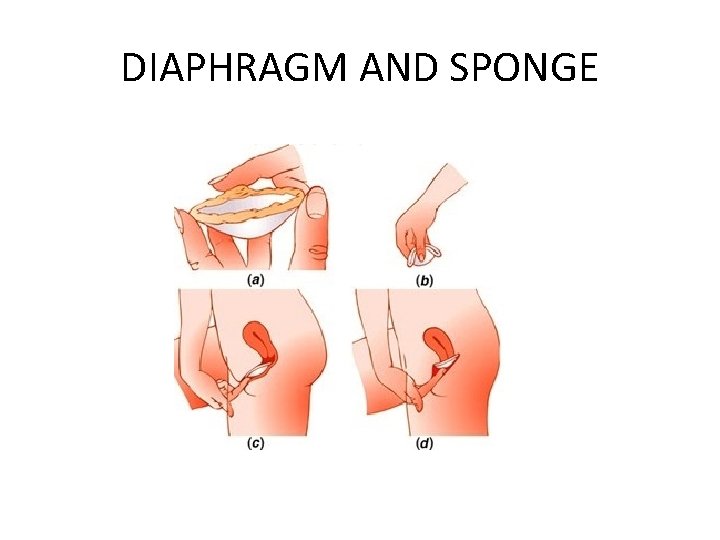 DIAPHRAGM AND SPONGE 