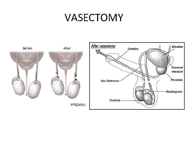 VASECTOMY 