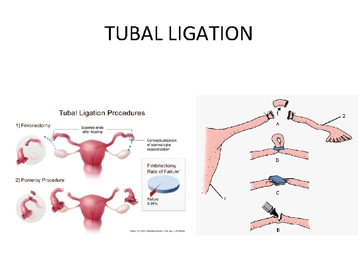 TUBAL LIGATION 