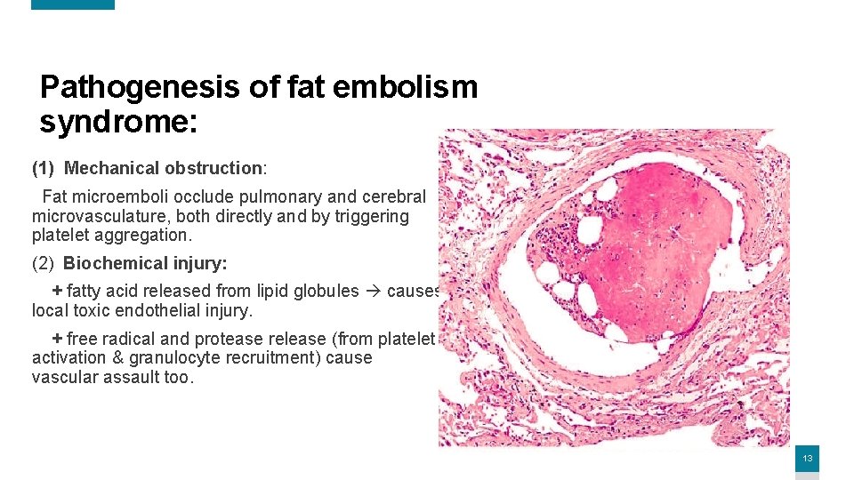 Pathogenesis of fat embolism syndrome: (1) Mechanical obstruction: Fat microemboli occlude pulmonary and cerebral