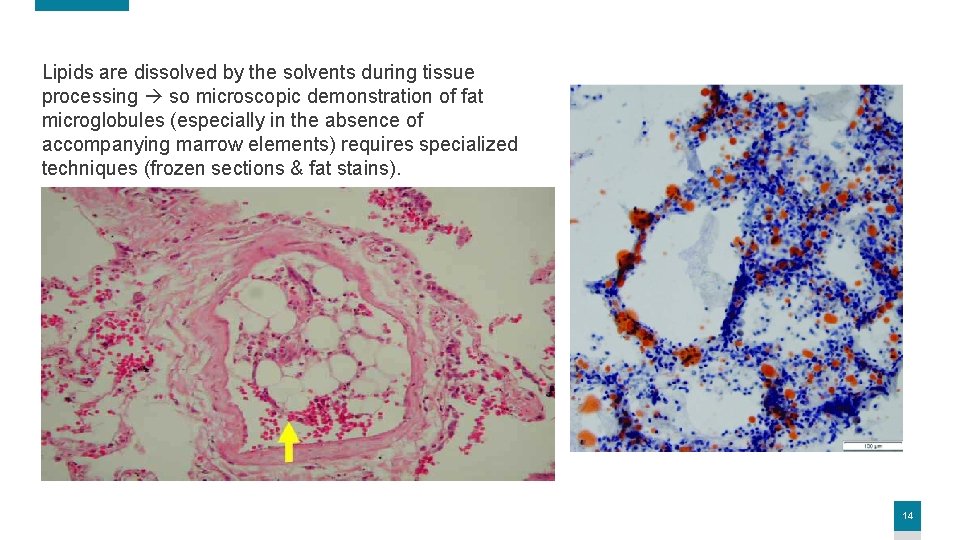Lipids are dissolved by the solvents during tissue processing so microscopic demonstration of fat