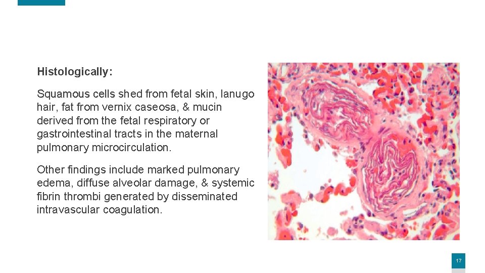 Histologically: Squamous cells shed from fetal skin, lanugo hair, fat from vernix caseosa, &