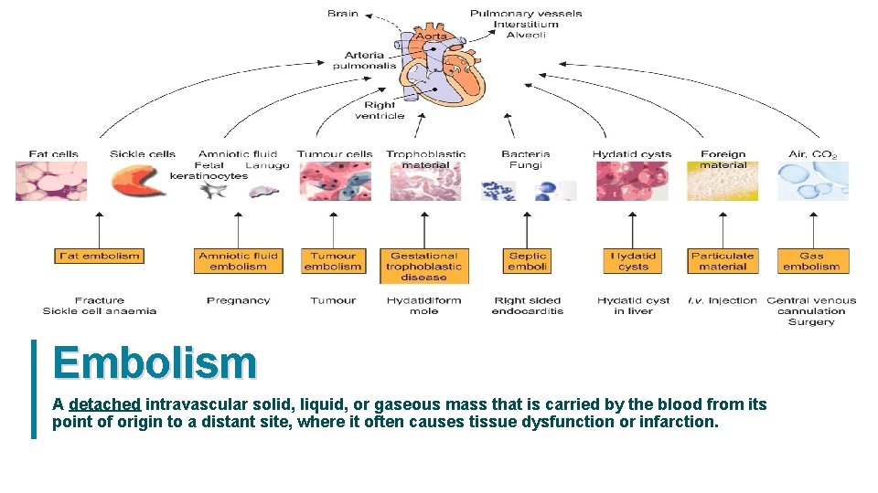 Embolism A detached intravascular solid, liquid, or gaseous mass that is carried by the