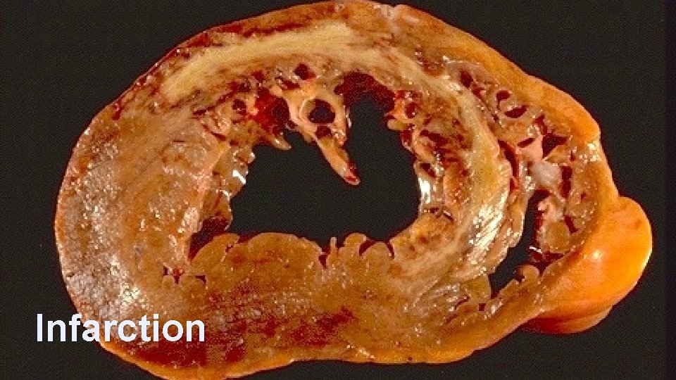 Morphology Infarction 22 