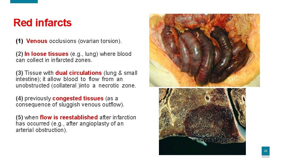 Red infarcts (1) Venous occlusions (ovarian torsion). (2) In loose tissues (e. g. ,