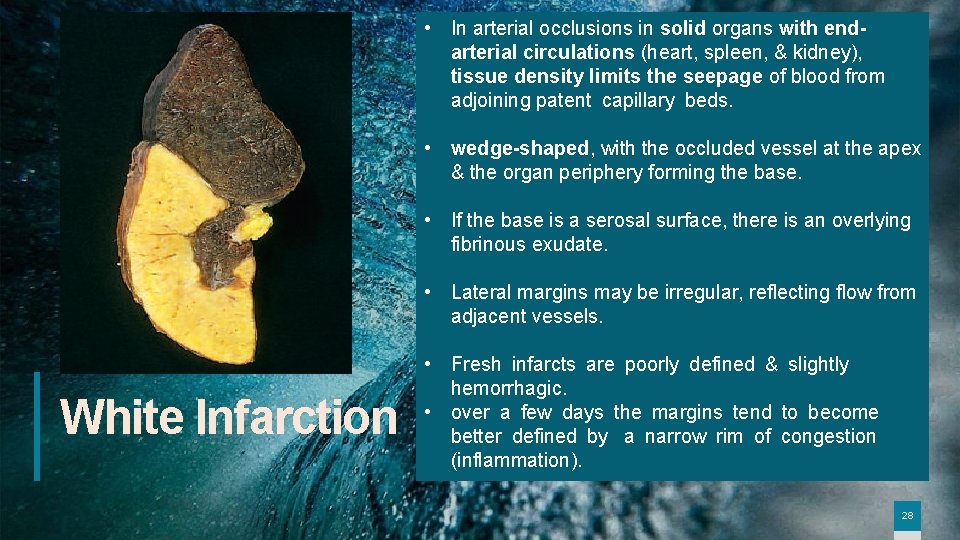  • In arterial occlusions in solid organs with endarterial circulations (heart, spleen, &