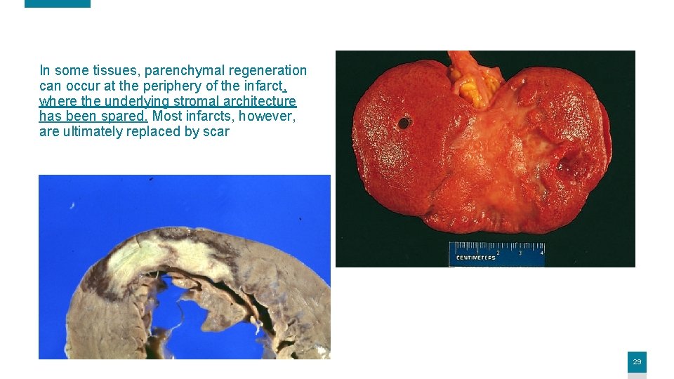 In some tissues, parenchymal regeneration can occur at the periphery of the infarct, where