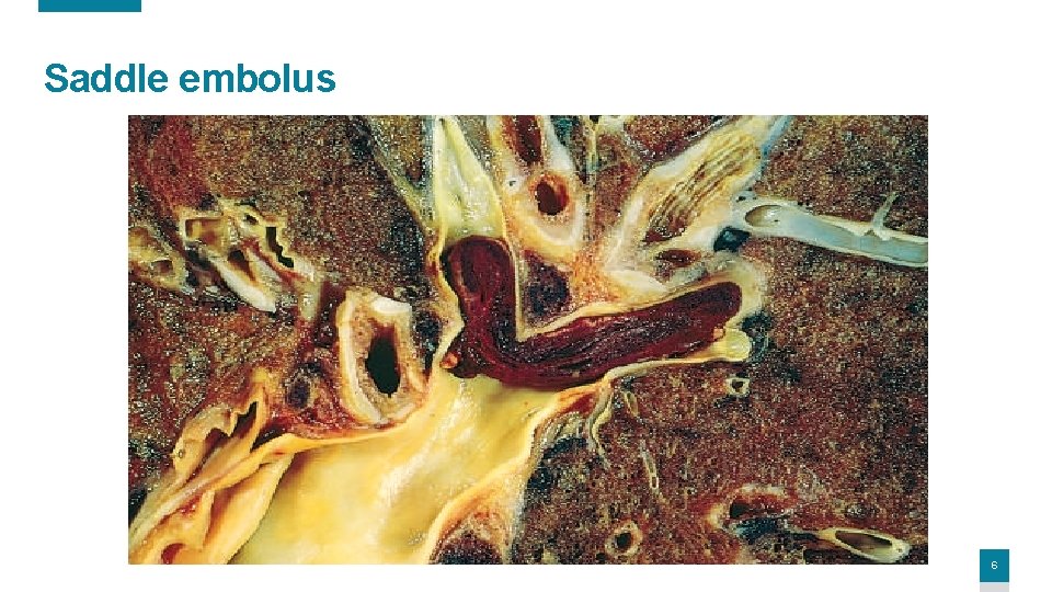 Saddle embolus 6 