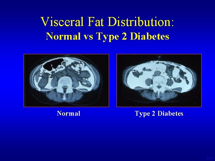 Visceral Fat Distribution: Normal vs Type 2 Diabetes Normal Type 2 Diabetes 2 -11