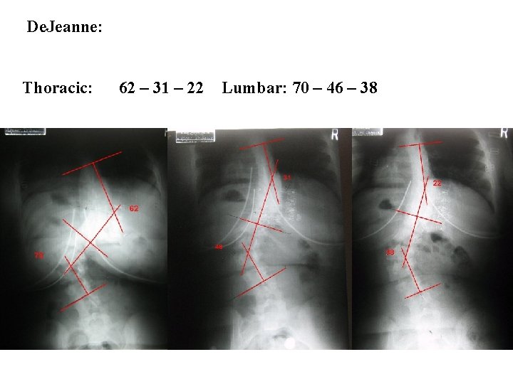 De. Jeanne: Thoracic: 62 – 31 – 22 Lumbar: 70 – 46 – 38