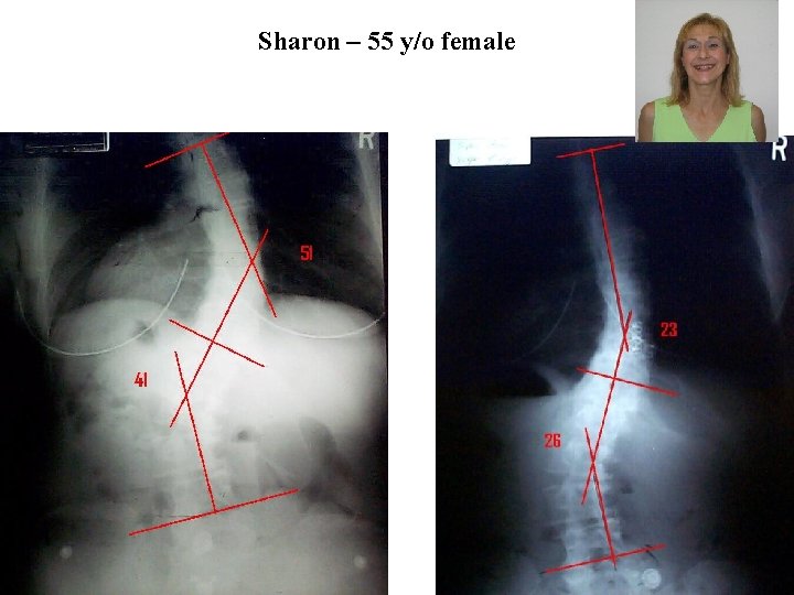 Sharon – 55 y/o female 