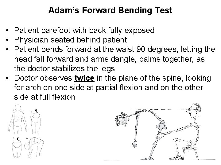 Adam’s Forward Bending Test • Patient barefoot with back fully exposed • Physician seated