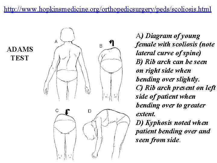 http: //www. hopkinsmedicine. org/orthopedicsurgery/peds/scoliosis. html ADAMS TEST A) Diagram of young female with scoliosis