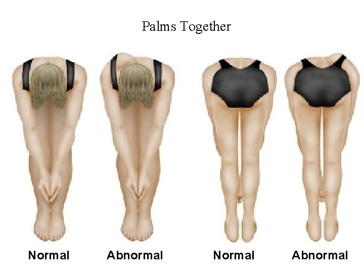 Palms Together Normal Abnormal 