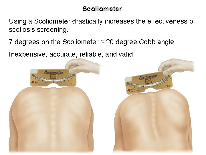 Scoliometer Using a Scoliometer drastically increases the effectiveness of scoliosis screening. 7 degrees on
