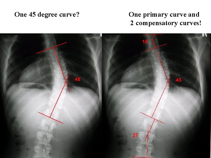 One 45 degree curve? One primary curve and 2 compensatory curves! 