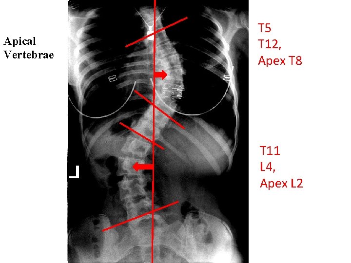 Apical Vertebrae T 5 T 12, Apex T 8 T 11 L 4, Apex