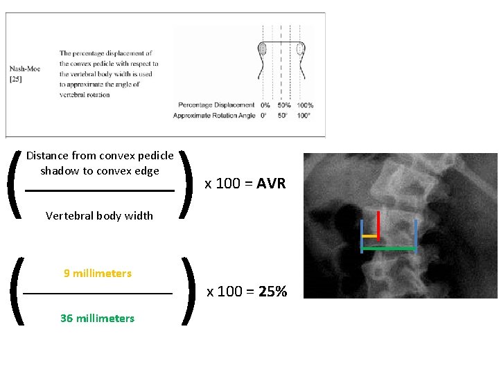 ( ( Distance from convex pedicle shadow to convex edge Vertebral body width 9