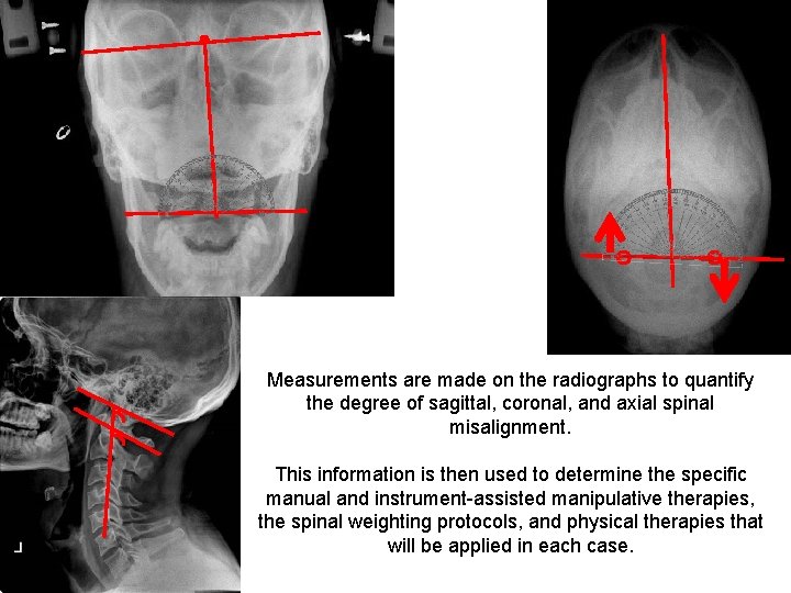 Measurements are made on the radiographs to quantify the degree of sagittal, coronal, and