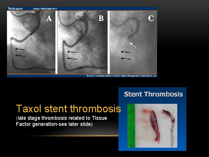 Taxol stent thrombosis (late stage thrombosis related to Tissue Factor generation-see later slide) 