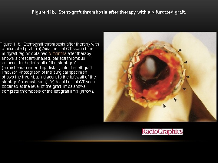 Figure 11 b. Stent-graft thrombosis after therapy with a bifurcated graft. (a) Axial helical