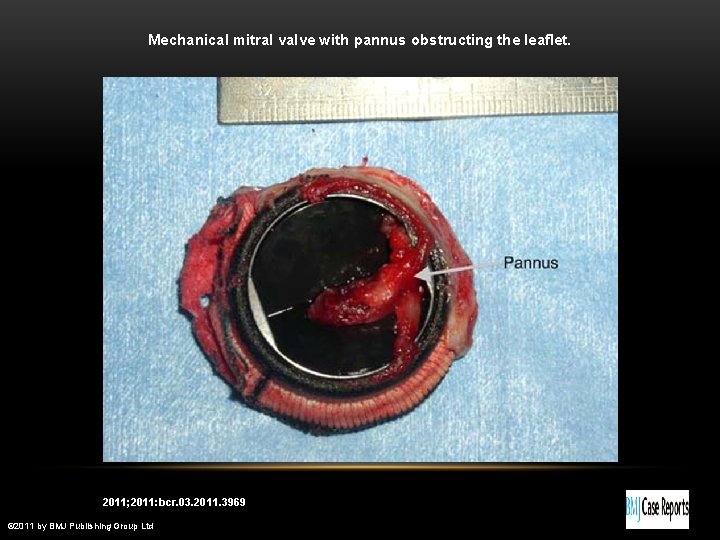 Mechanical mitral valve with pannus obstructing the leaflet. Imran U H et al. BMJ