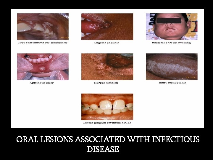 ORAL LESIONS ASSOCIATED WITH INFECTIOUS DISEASE 