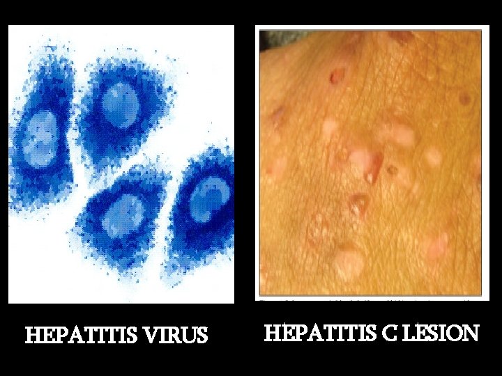 HEPATITIS VIRUS HEPATITIS C LESION 