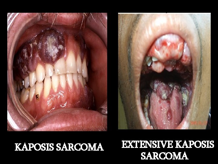 KAPOSIS SARCOMA EXTENSIVE KAPOSIS SARCOMA 