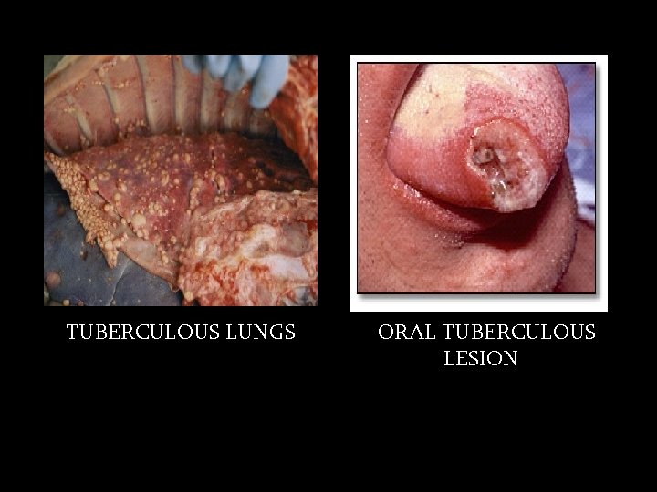 TUBERCULOUS LUNGS ORAL TUBERCULOUS LESION 
