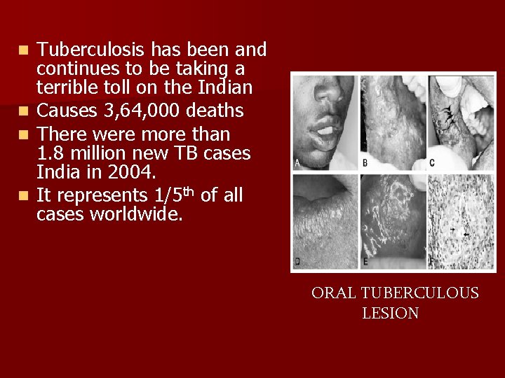 n n Tuberculosis has been and continues to be taking a terrible toll on