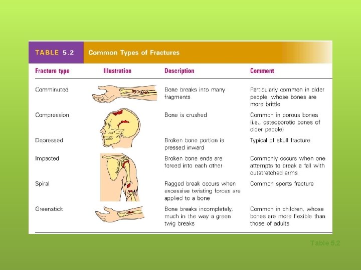 Common Types of Fractures Table 5. 2 