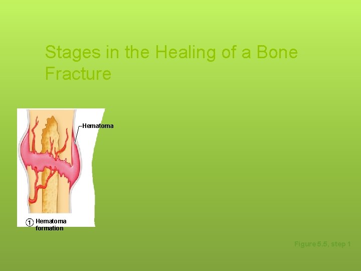 Stages in the Healing of a Bone Fracture Hematoma formation Figure 5. 5, step