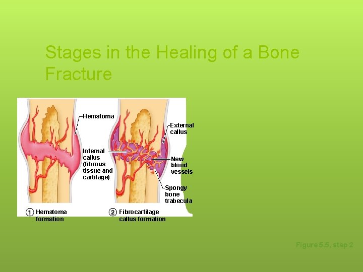 Stages in the Healing of a Bone Fracture Hematoma External callus Internal callus (fibrous