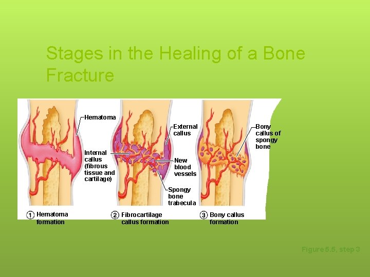 Stages in the Healing of a Bone Fracture Hematoma External callus Internal callus (fibrous