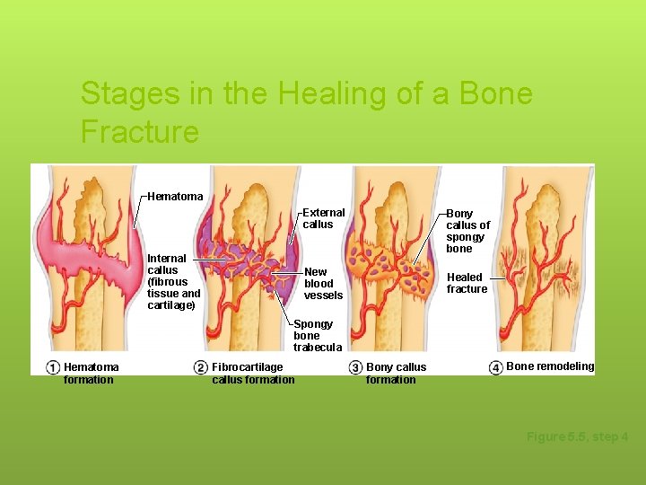 Stages in the Healing of a Bone Fracture Hematoma Internal callus (fibrous tissue and