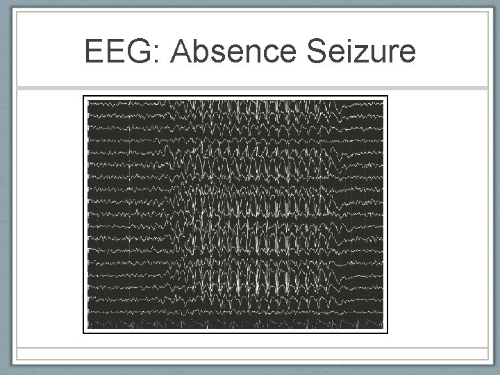 EEG: Absence Seizure American Epilepsy Society 2010 