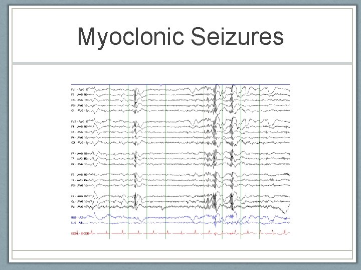 Myoclonic Seizures American Epilepsy Society 2010 