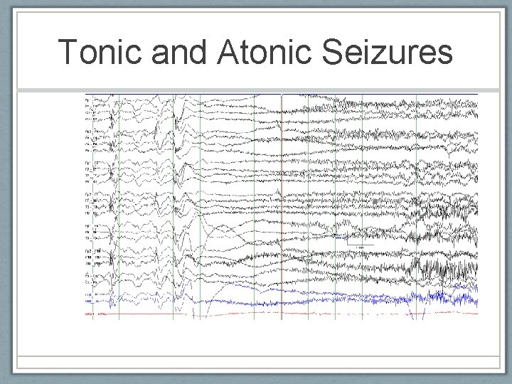 Tonic and Atonic Seizures American Epilepsy Society 2010 