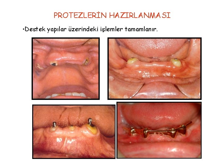 PROTEZLERİN HAZIRLANMASI • Destek yapılar üzerindeki işlemler tamamlanır. 