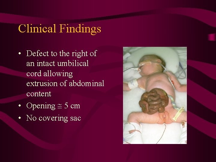 Clinical Findings • Defect to the right of an intact umbilical cord allowing extrusion