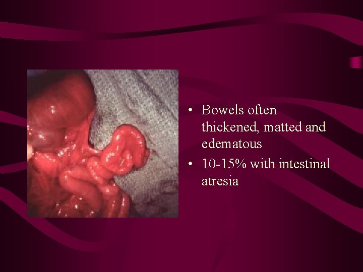 • Bowels often thickened, matted and edematous • 10 -15% with intestinal atresia