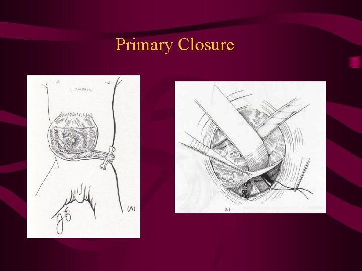 Primary Closure 