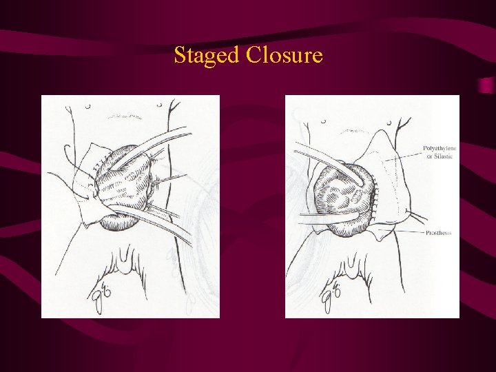 Staged Closure 