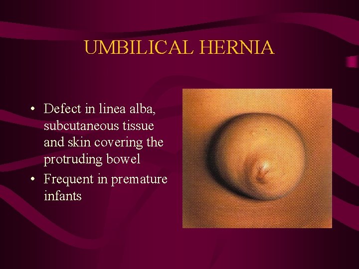 UMBILICAL HERNIA • Defect in linea alba, subcutaneous tissue and skin covering the protruding