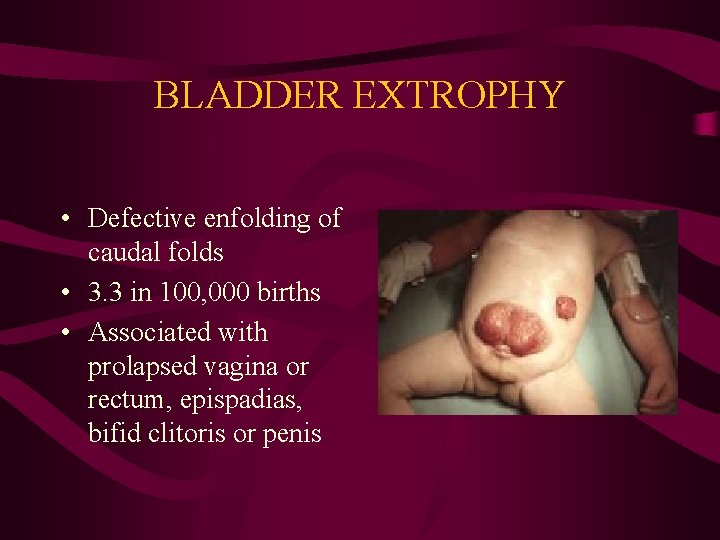 BLADDER EXTROPHY • Defective enfolding of caudal folds • 3. 3 in 100, 000